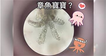 女大生狂冒痘！檢查驚見「章魚寶寶」大量繁殖　醫示警1行為：在餵蟲