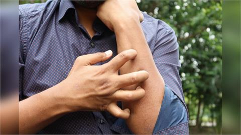 一出門秒被叮滿身包？專家曝「蚊子最愛2種人」吃5類食物更易中招