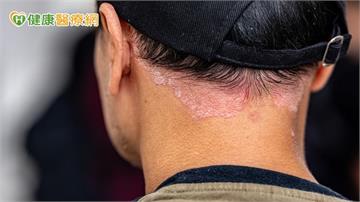 染新冠後全身爆膿疱！醫揭「罕見免疫反應」：與基因突變有關