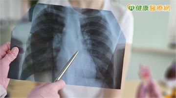 晚期EGFR突變型肺癌治療怎麼選？醫：大型臨床證據、治療指引是重要參考
