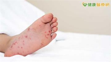 腸病毒疫情緩升增1重症!未滿5歲女童染D68型 8重症警訊須留意