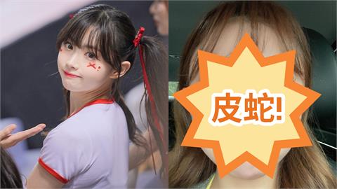 金娜妍1天只睡2小時出事了！「眼睛長皮蛇」發高燒+全身痛…她嘆：恐永久留疤
