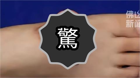 中國女工「左耳帶頭皮」被機器扯斷！耳朵奇蹟「寄生」腳背5個月後成功復位…