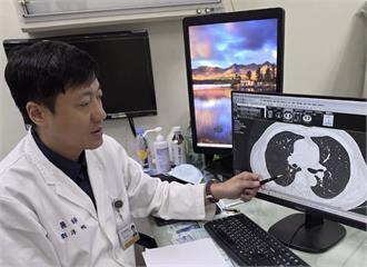 兄妹皆罹癌   他「0.7cm結節藏肺葉深處」也侵襲性肺腺癌！