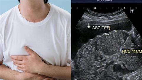 40歲男以為只是「胃脹氣」　醫一查竟發現「這地方」長11公分腫瘤！