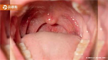 手機2分鐘揪口腔癌！台大AI快篩準確率破95％ 2027年臨床應用