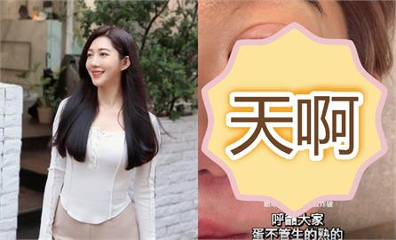 8點檔林志玲「微波爐煮雞蛋」爆炸！眼角膜破洞、皮膚燙傷「送醫慘況曝」