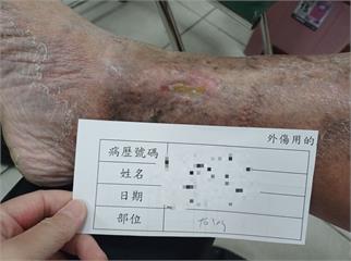 「洗澡得套塑膠袋」傷口潰爛十多年! 禍首竟是靜脈曲張