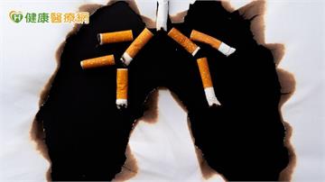 肺癌第一期五年存活逾九成　低劑量電腦斷層篩檢揪苗頭