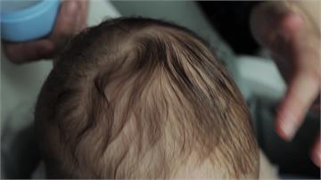 我的孩子掉頭髮正常嗎？家長必備初步判斷指南一次看　醫揭照護「3關鍵」