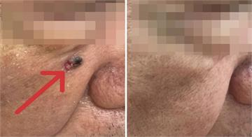 男臉上冒黑斑「不痛不癢」   再一看長大了！竟是皮膚基底細胞癌