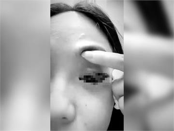 快新聞／好可怕！中和24歲女慘遭前男友痛毆　釀左眼流血、水晶體脫落