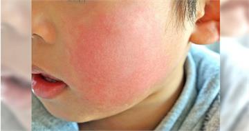 臉頰發紅要注意!日本「蘋果病」增加 醫:3族群應特別小心