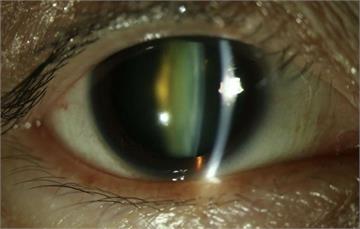 連換多副眼鏡仍看不清？   眼冒「4大症狀」恐已白內障