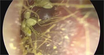1歲童狂抓耳就診！耳道口驚見「植物種子」　醫一照驚呆：發芽了