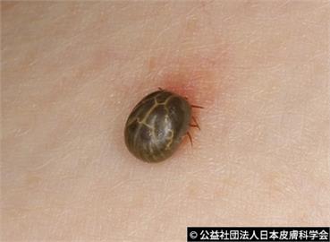 赴日山區注意！　蜱蟲傳染「SFTS」病患創新高　有死亡風險