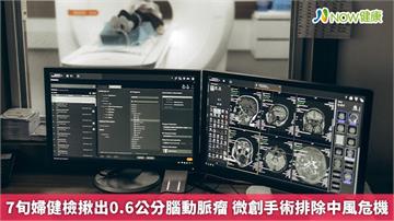 7旬婦健檢揪出0.6公分腦動脈瘤　微創手術排除中風危機