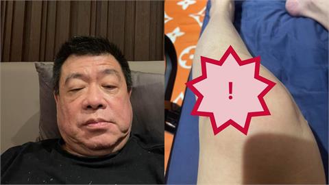聲援于朦朧收死亡威脅 孫德榮突曬傷勢照曝「4天摔3次」:再跌恐上西天!