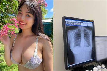 寫真偶像炫耀「肺很乾淨」曬X光照！超扯畫面3千萬網友全歪樓：重點不在肺