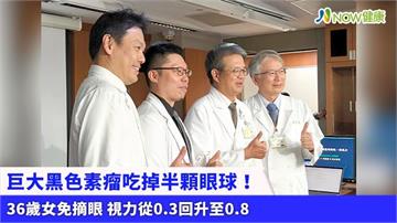 巨大黑色素瘤吃掉半顆眼球！36歲女免摘眼 視力從0.3回升至0.8