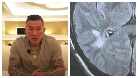 快新聞/館長開直播秀X光片 自爆「腦有問題」