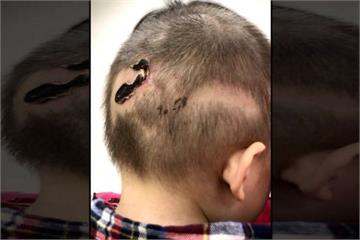 1歲男童遭比特犬攻擊 頭蓋骨粉碎險喪命