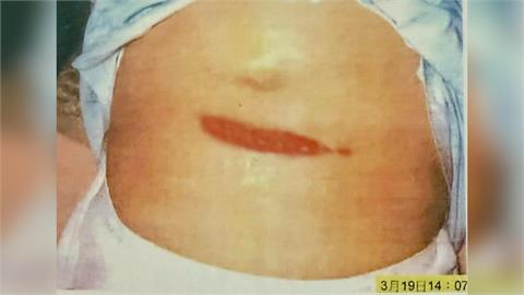 快新聞／319槍擊案22週年！陳水扁公布傷口照　嘆「沒有新發現就應結案」