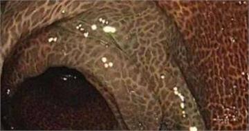 喝通便茶10年！陸女連5天拉不出送醫　慘變「豹紋腸」切30cm保命