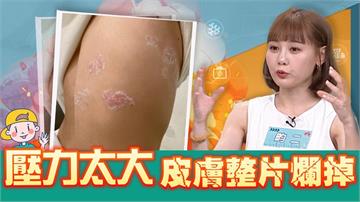 畇二熬夜到天亮竟染「皮蛇」!醫揭「這事」太少恐釀壓力荷爾蒙飆升！