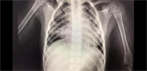 RSV爆發中！2歲童「咳不停狂燒」急診兒科醫：嚴重恐要插管