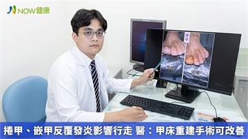 捲甲、嵌甲反覆發炎影響行走 醫：甲床重建手術可改善