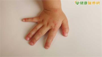 腸病毒重症添2例!國中生手腳無力住ICU 未滿5歲童腦炎搶救中