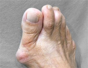 拇指外翻怎根治？關鍵在於嚴重程度！醫師一次解析：常見「5症狀」、「2種」治療方式！
