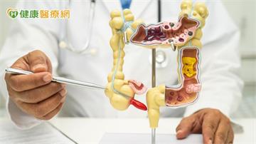 腸癌「TNT治療」保留肛門！適用癌友多