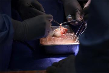 他先移植豬腎逃離洗腎地獄9個月　成功等到人類器官迎新生