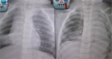 1歲童被餵整顆花生「肺部塌陷」！　醫氣炸曝：死死塞住支氣管