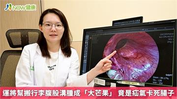 運將幫搬行李腹股溝腫成「大芒果」 竟是疝氣卡死腸子