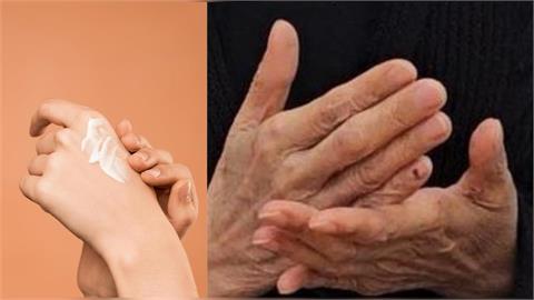 74歲婦「擦藥擦到洗腎」？醫點名外用藥「1成分」過量恐滲入腎臟！