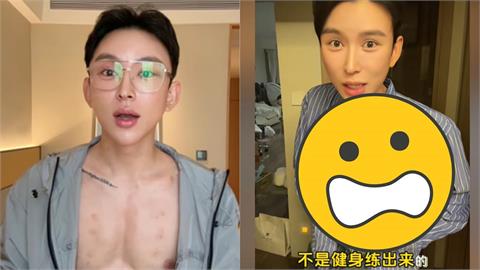 中國扁身網紅砸1745萬「打玻尿酸造人工8塊肌」！猛炸起伏太扯…專家急揭超慘後果