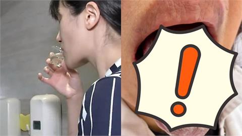 婦患牙周病「狂灌強效漱口水」　她「整根舌頭變灰色」醫示警快停下！