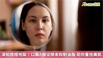深陷痘痘地獄！口服A酸從根本抑制油脂 助你重拾美肌