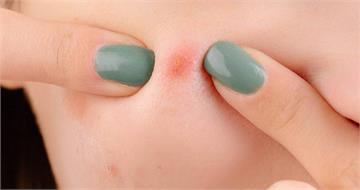 擠完粉瘤又復發？皮膚科醫師揭真相：沒切除「這東西」
