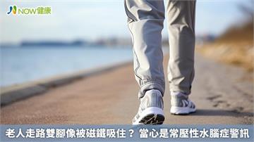 老人走路雙腳像被磁鐵吸住? 當心是常壓性水腦症警訊