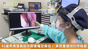 48歲男兩度鼻部手術後罹空鼻症！ 鼻腔重建找回呼吸感