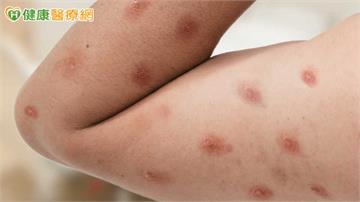 20多歲男染M痘！疾管署：台灣首見Ib型病毒株　小心5大皮膚症狀