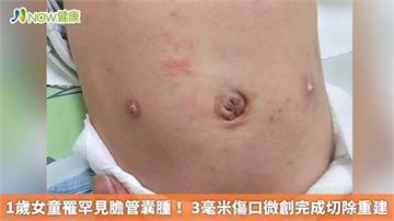 1歲女童罹罕見膽管囊腫！ 3毫米傷口微創完成切除重建