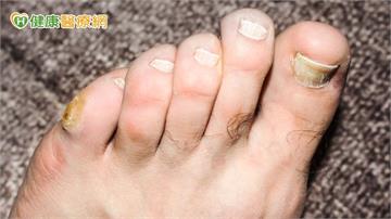 糖友穩定控制血糖卻忽略糖尿病足！醫及時救回避免截肢
