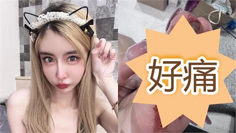 雪碧出事送急診「鐵片削兩塊肉」傷勢曝！2個月前才慘摔「肋骨插內臟」痛哭