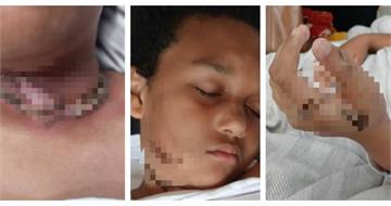 睡夢中突聽「爆炸聲」！　9歲男童平板充電竟讓項鍊起火灼傷