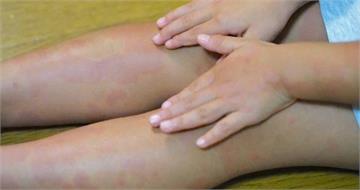 4歲女童全身紅疹染梅毒！　感染原因竟是「奶奶用嘴餵食」